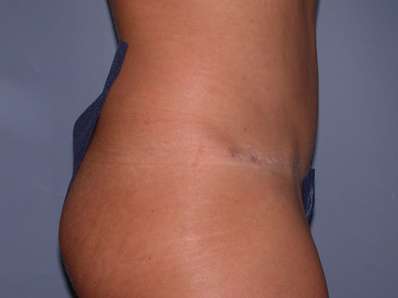 After — Tummy Tuck on 48-year-old
