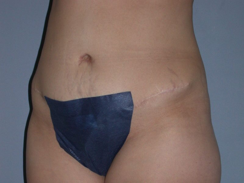 After — Tummy Tuck on 49-year-old