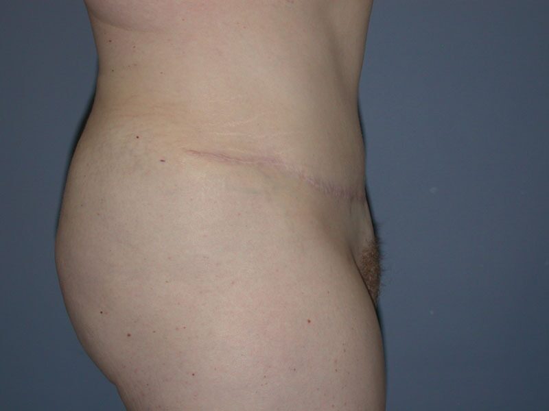 After — Tummy Tuck on 34-year-old