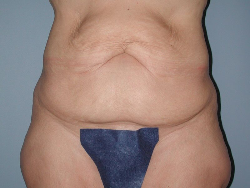 Before — Tummy Tuck
