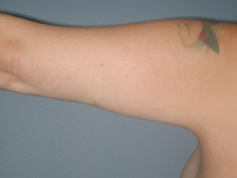 After — Arm Lift (Brachioplasty)