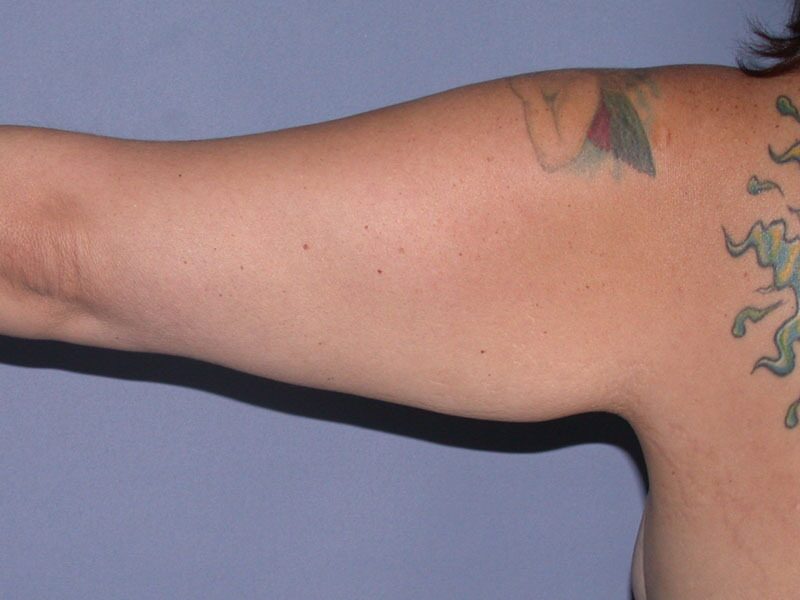 Before — Arm Lift (Brachioplasty)