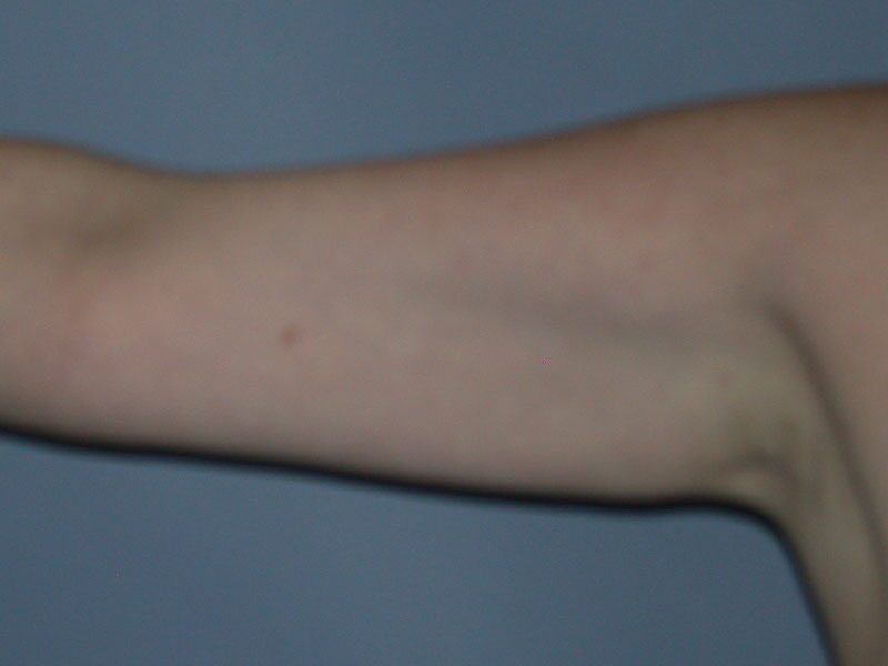 After — Arm Lift (Brachioplasty)