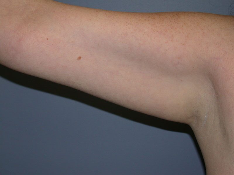 Before — Arm Lift (Brachioplasty)