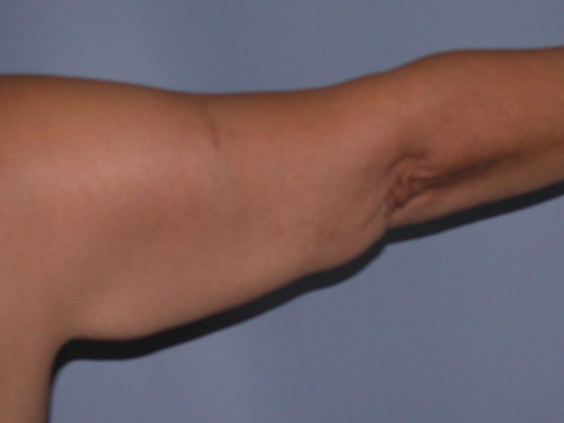 Before — Arm Lift (Brachioplasty)