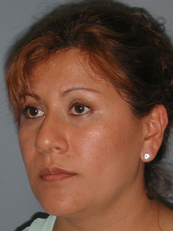 Before — Nose Surgery