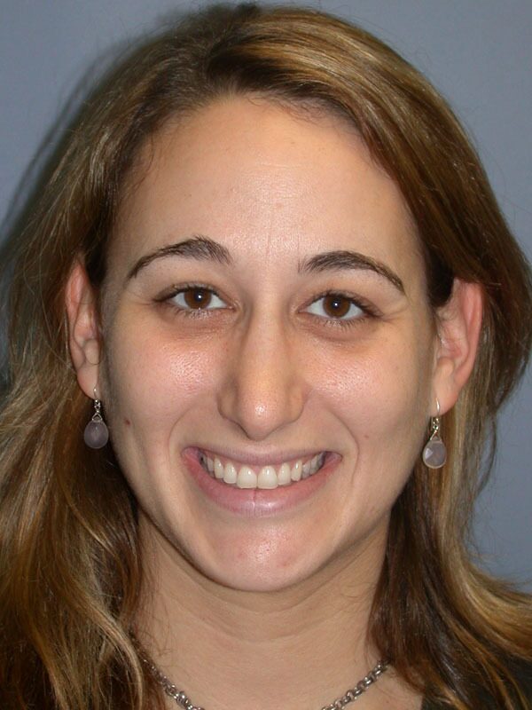 After — Nose Surgery