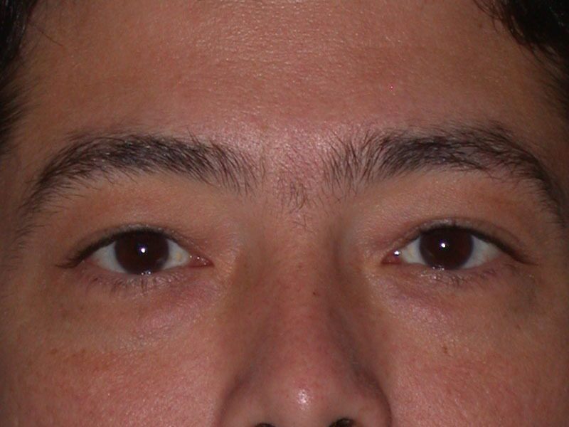 Before — Eyelid Surgery