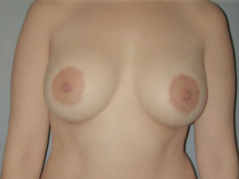 After — Breast Lift (Mastopexy) by Dr. Nichter