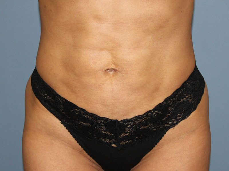 After — Liposuction