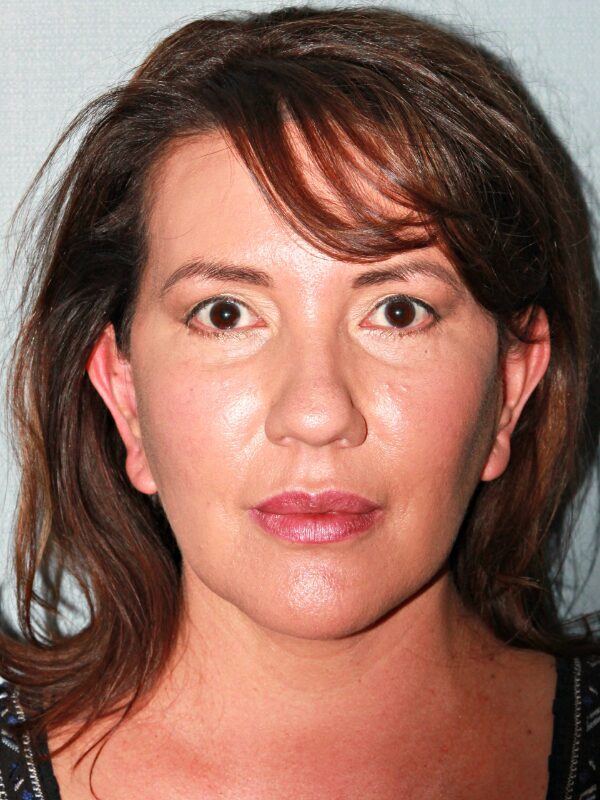After — 45-54 year old woman treated with Deep Plane Facelift