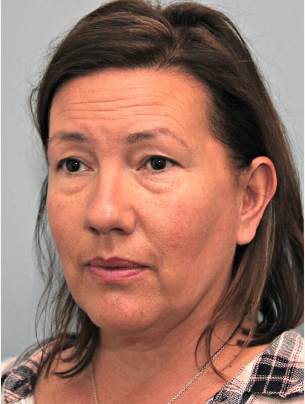 Before — 49 year old woman treated with Deep Plane Facelift