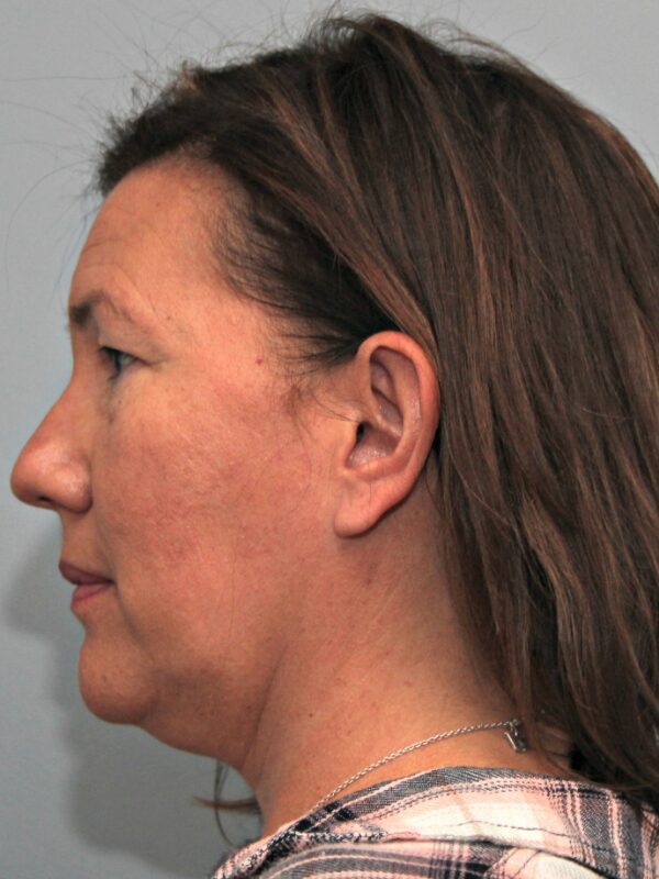 Before — 49 year old woman treated with MACS Facelift