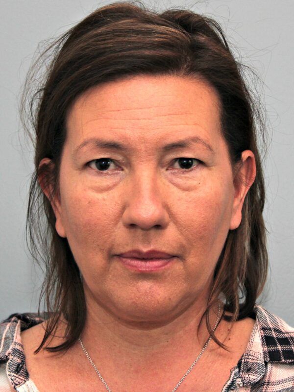 Before — 49 year old woman treated with Neck Lift