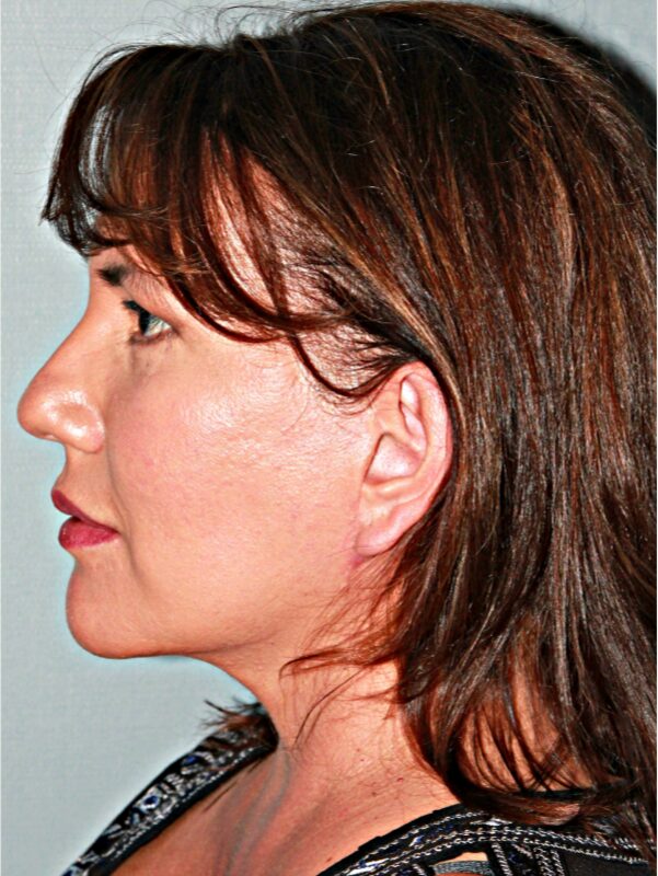 After — 49 year old woman treated with SMAS Facelift