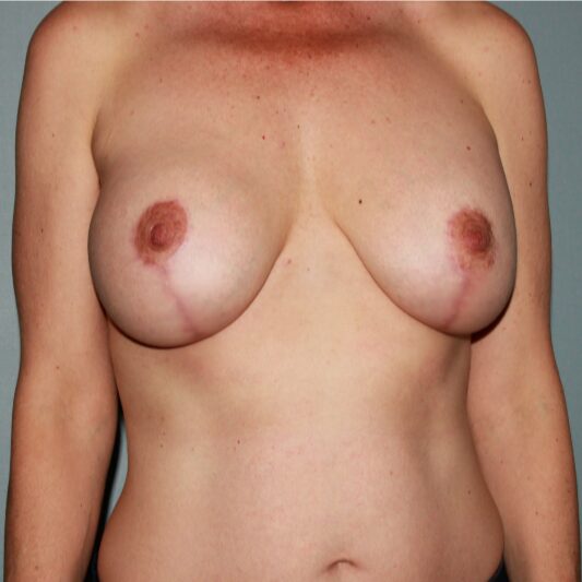 After — 42 year old woman treated with Breast Lift with Implants