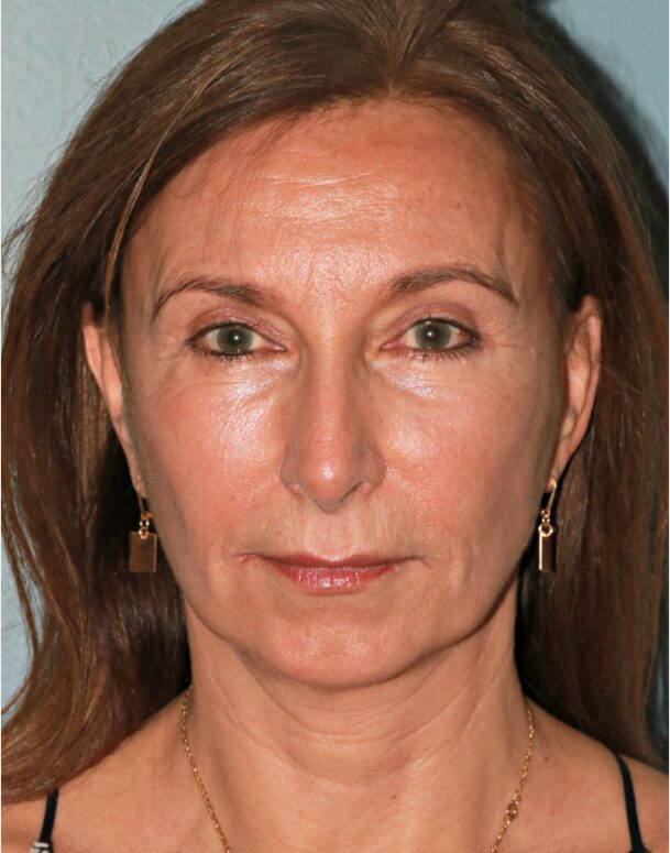 After — 61 year old woman treated with Deep Plane Facelift