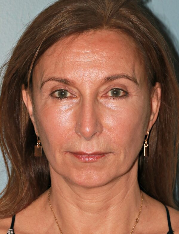 After — 61 year old woman treated with Double Eyelid Surgery