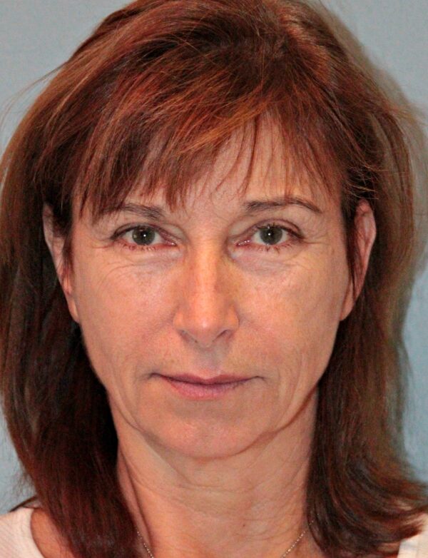 Before — 61 year old woman treated with Double Eyelid Surgery