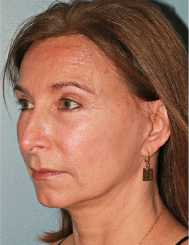 After — 61 year old woman treated with Double Eyelid Surgery
