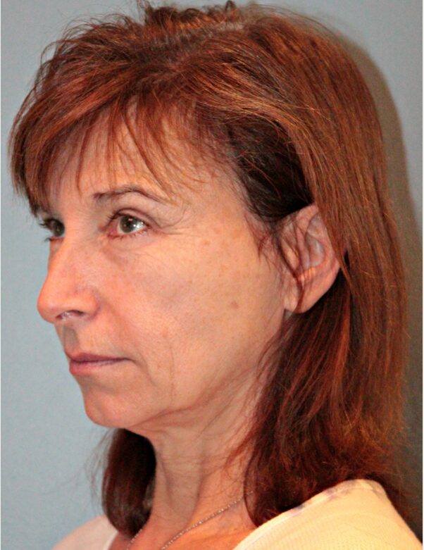 Before — 61 year old woman treated with Double Eyelid Surgery
