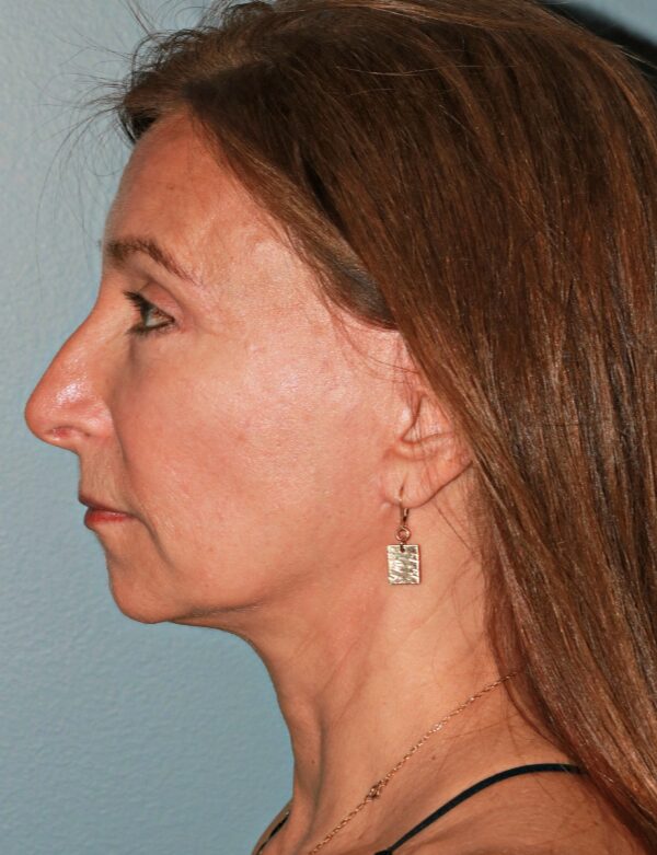 After — 61 year old woman treated with Double Eyelid Surgery