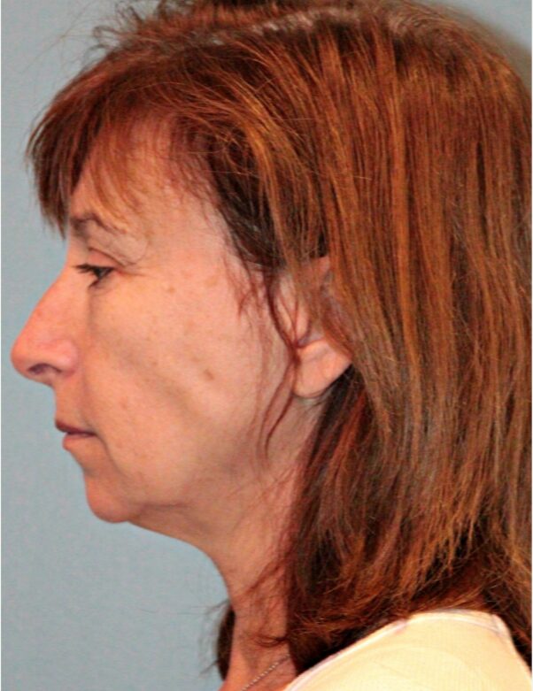 Before — 61 year old woman treated with Double Eyelid Surgery