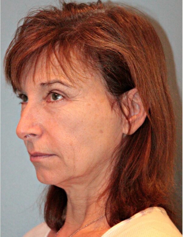 Before — 61 year old woman treated with Facelift