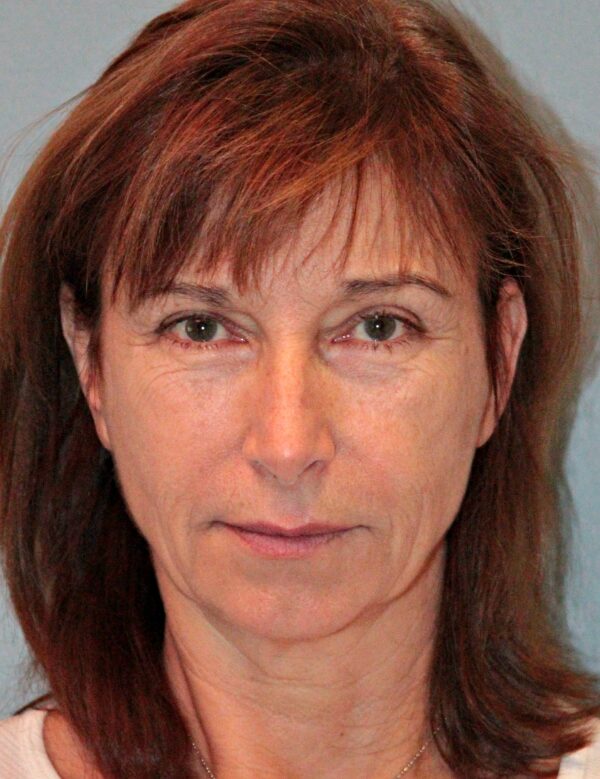 Before — 61 year old woman treated with Facial Fat Transfer