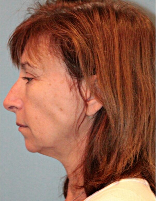 Before — 61 year old woman treated with Lifestyle Lift