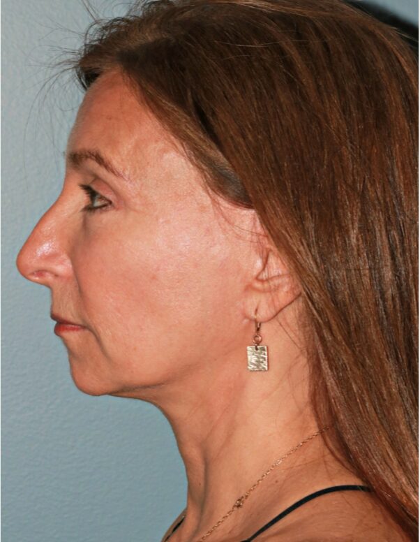 After — 61 year old woman treated with Lower Face Lift