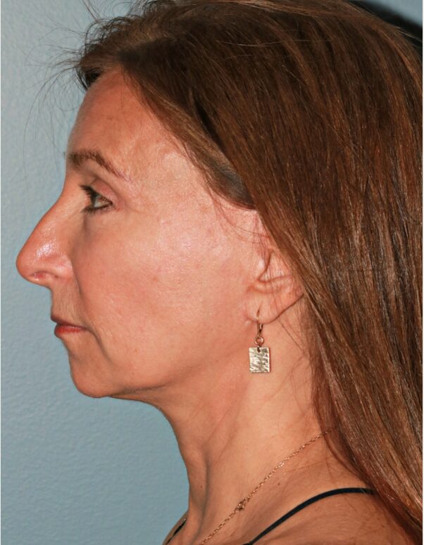 After — 61 year old woman treated with MACS Facelift