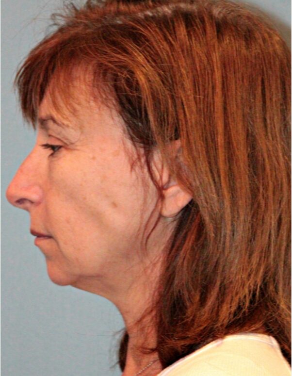 Before — 61 year old woman treated with MACS Facelift