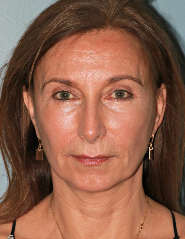 After — 61 year old woman treated with SMAS Facelift