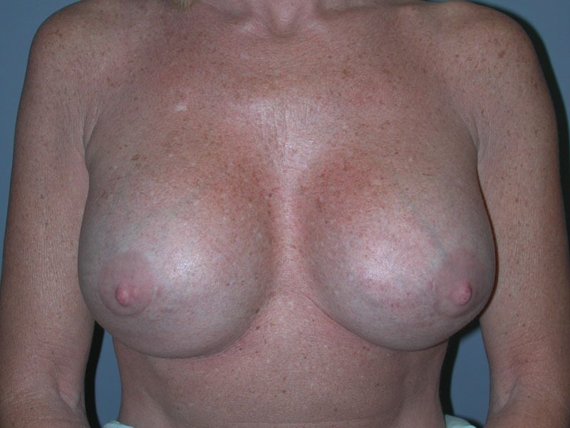 After — Breast Implant Revision