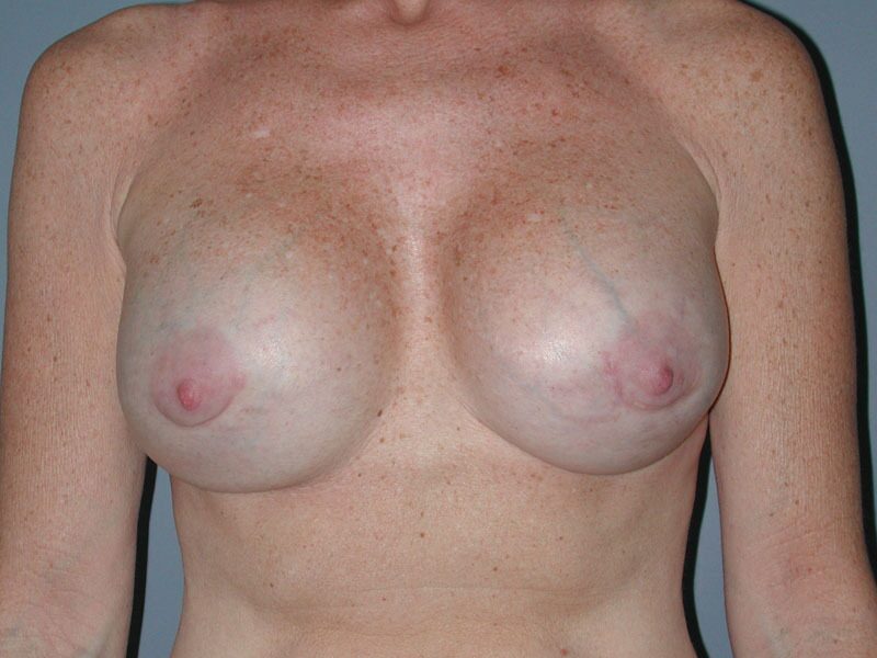 Before — Breast Implant Revision