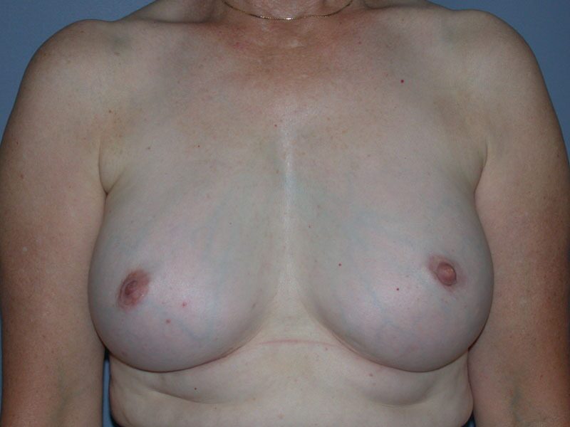 After — Implant Exchange, Revisio, Capsulectomy