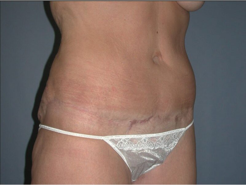 After — 35-44 year old woman treated with Tummy Tuck