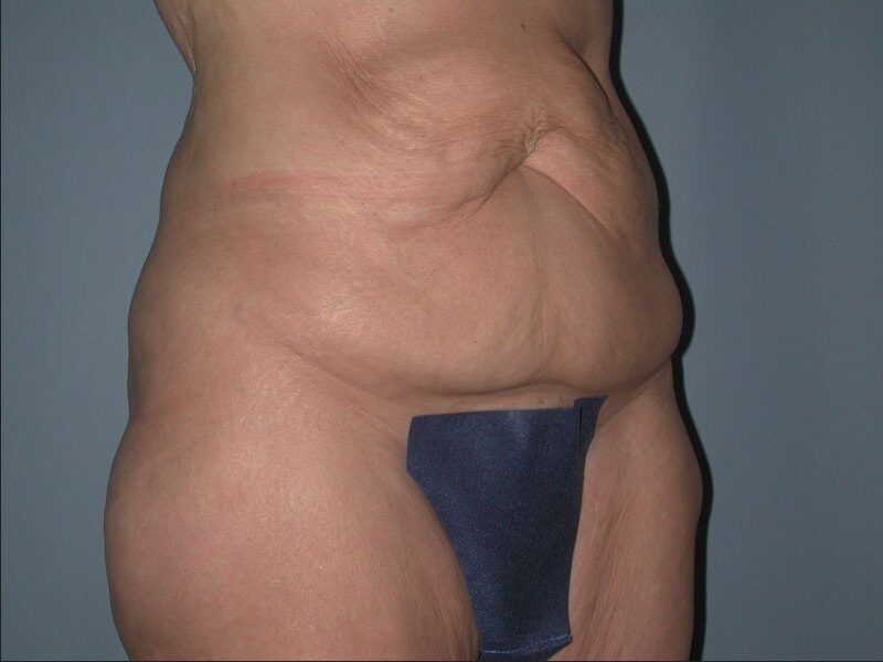 Before — 35-44 year old woman treated with Tummy Tuck