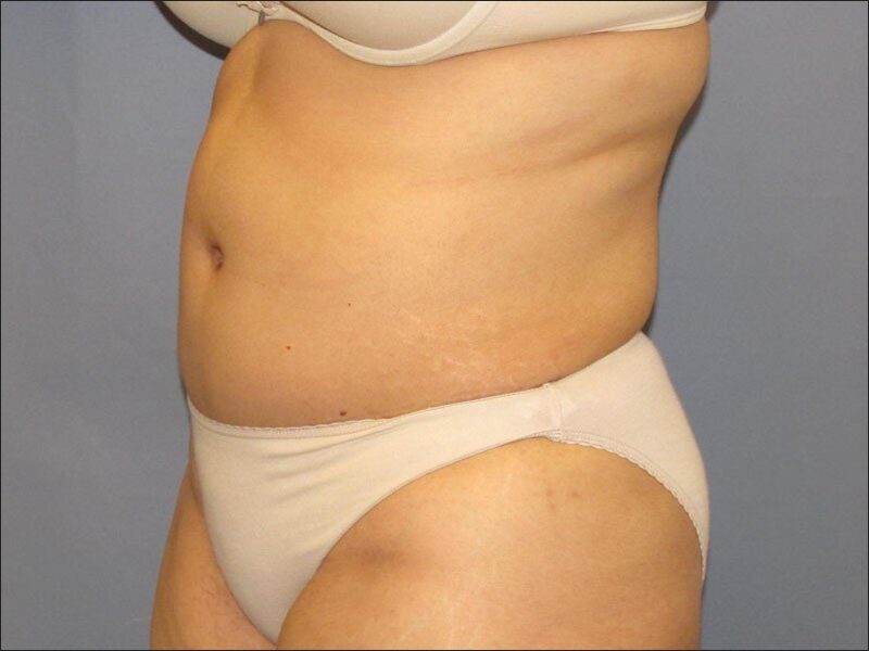 After — 45-54 year old woman treated with Tummy Tuck