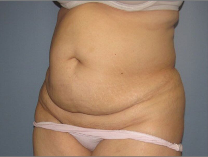 Before — 45-54 year old woman treated with Tummy Tuck