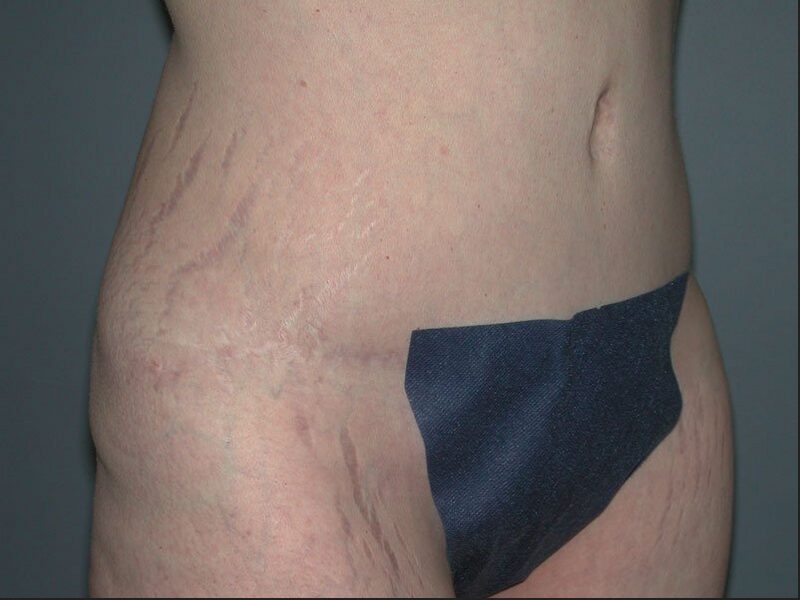 After — 35-44 year old woman treated with Tummy Tuck