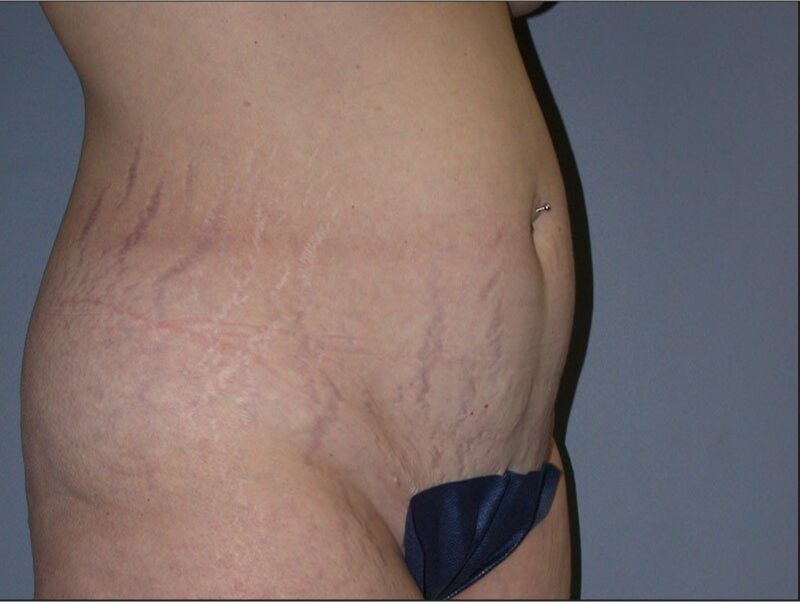 Before — 35-44 year old woman treated with Tummy Tuck