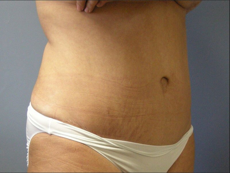 After — 35-44 year old woman treated with Tummy Tuck