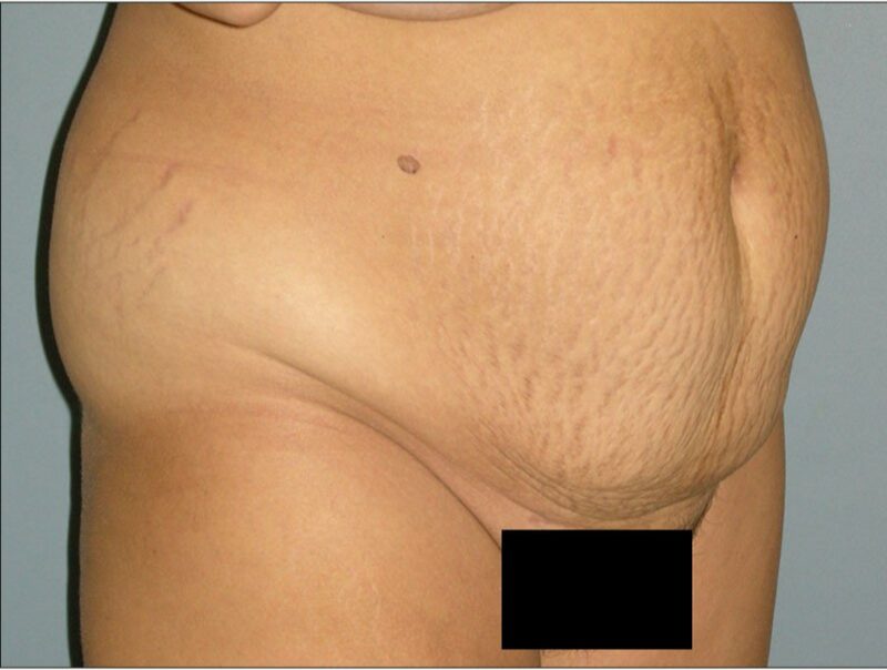 Before — 35-44 year old woman treated with Tummy Tuck
