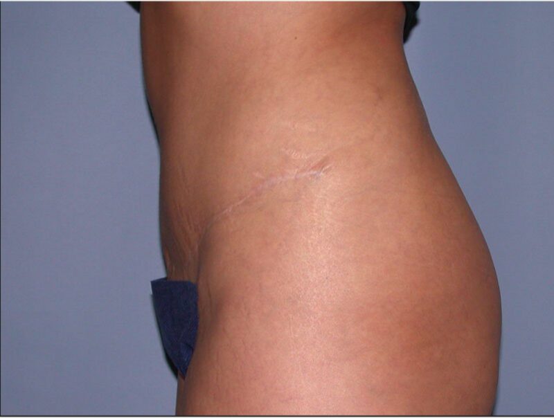 After — 25-34 year old woman treated with Tummy Tuck