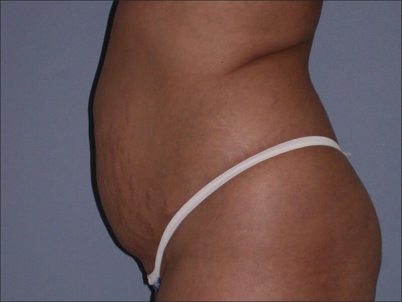Before — 25-34 year old woman treated with Tummy Tuck