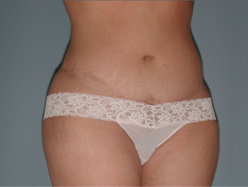 After — Woman treated with Tummy Tuck