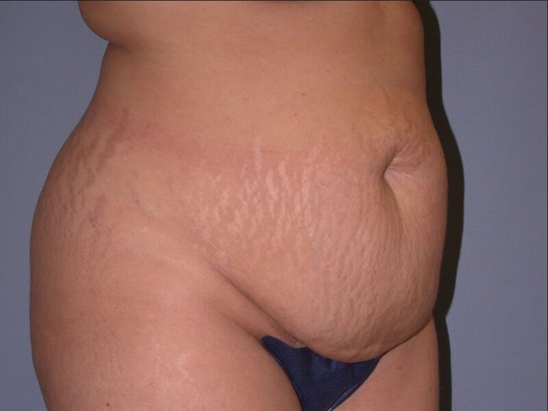 Before — Woman treated with Tummy Tuck