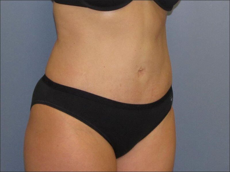 After — 35-44 year old woman treated with Tummy Tuck